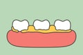 Plaque or tartar, cause of tooth periodontal disease