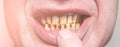 Plaque teeth cavities and paradontosis in the man`s mouth. Dental decay problems and bad smile. Dentist treatment, health care