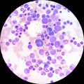 Plasma cells in multiple myeloma Royalty Free Stock Photo