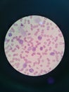 Plasmodium falciparum in blood