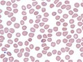 Plasmodium falciparum in peripheral blood.