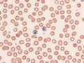 Plasmodium malariae schizontes in peripheral blood. Royalty Free Stock Photo