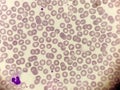 Plasmodium sp malaria in erythrocyte. Parasite in red blood cells. Blood smear