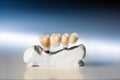 Plaster model with a bridge made on a two-tooth implant Royalty Free Stock Photo