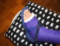 A broken ankle with purple plaster