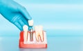 Plastic samples of dental implants compare with natural teeth