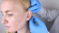 A plastic surgeon examines a patient`s auricle. The doctor sees a tubercle on the curl of the ear.