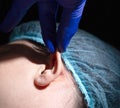 A plastic surgeon performs an operation to correct the ears of a female patient. Otoplasty, elimination of protruding