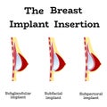 Plastic surgery of breast implant
