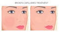 Plastic surgery_Broken Capillaries Treatment