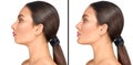 Before and after plastic surgery of a chin. Cosmetic correction small weak chin, plastic surgery of a chin, reduction surgery Royalty Free Stock Photo