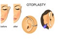 Plastic surgery. correction of protruding ears Royalty Free Stock Photo