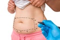 Plastic surgery doctor draw lines with marker on patient belly