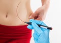 Plastic surgery doctor draw lines with marker on patient belly - isolated on white background Royalty Free Stock Photo