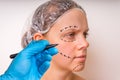 Plastic surgery doctor draw lines with marker on patient face Royalty Free Stock Photo