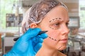 Plastic surgery doctor draw lines with marker on patient face