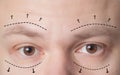 Plastic surgery of eyebrows in men, lower and upper eyelids. The concept of the modern blepharoplasty procedure, lifting, close-up