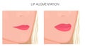 Plastic surgery_Lip Augmentation