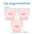 Plastic surgery lip