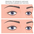 Plastic surgery_Removal of wrinkles around the outer corners of