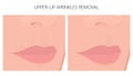 Plastic surgery_Upper-lip wrinkles removal Royalty Free Stock Photo