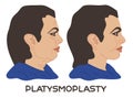 Plastysmoplasty. Before and after Royalty Free Stock Photo