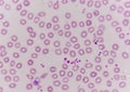 Platelet clumping as a possible cause of low platelet count in p