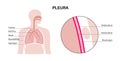 Pleura anatomical poster