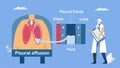 Pleural effusion is collection of excess fluid between layers of pleura outside lungs. Pulmonology vector illustration about