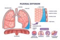 Pleural effusion diagram depicts fluid in pleural space compressing a ... Royalty Free Stock Photo