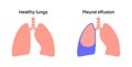 Pleural effusion poster