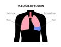 Pleural effusion poster