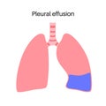 Pleural effusion poster