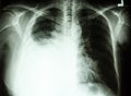 Pleural effusion due to lung cancer Royalty Free Stock Photo