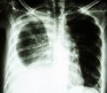 Pleural effusion due to lung cancer Royalty Free Stock Photo