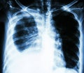 Pleural effusion due to lung cancer