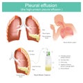 Pleural effusion the high-protein pleural effusion. Royalty Free Stock Photo