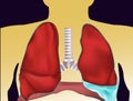 Pleural effusion - liquid in pleural cavity