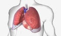 Pleural effusion is a lung condition characterized by fluid buildup outside the lungs