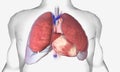 Pleural effusion is a lung condition characterized by fluid buildup outside the lungs