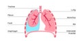 Pleural effusion poster