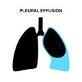 Pleural effusion poster