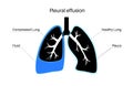 Pleural effusion poster