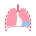 Pleural effusion poster