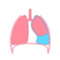 Pleural effusion poster