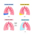 Pleural effusion poster