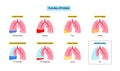 Pleural effusion poster