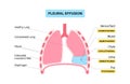 Pleural effusion poster