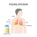 Pleural effusion. Treatment of tension hydrothorax Royalty Free Stock Photo