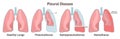 Pleural effusions. Abnormal gathering of blood or air in pleural space.